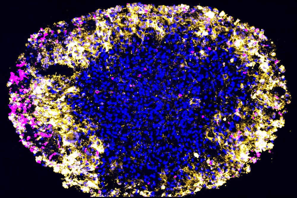 glioblastoma microscopic image
